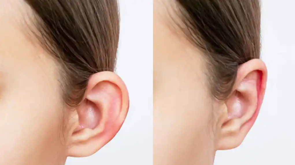 Imagen de otoplastia